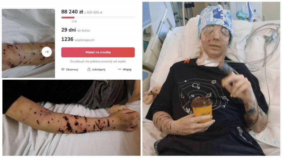 Weronika pogryziona przez sforę psów potrzebuje pół miliona zł na leczenie! Ruszyła zbiórka na ten cel